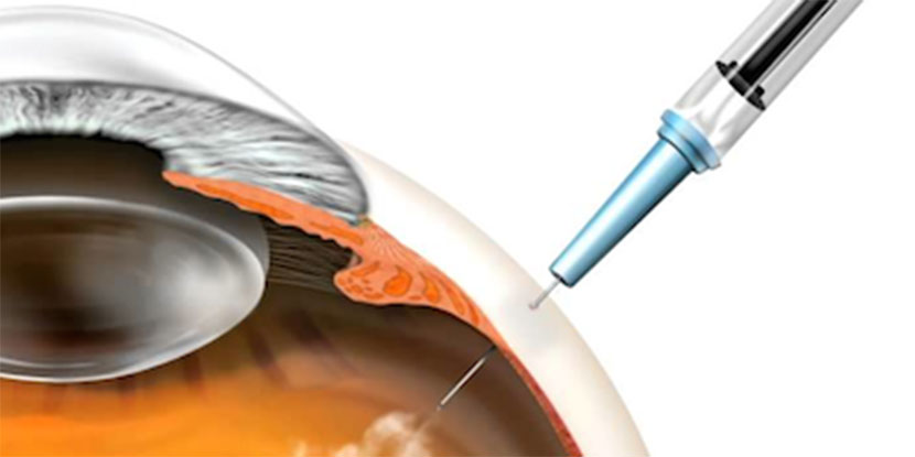 Wet Amd Injections