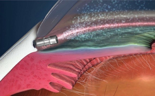 US FDA Accepts Glaukos’ NDA for iDose TR Implant for Glaucoma