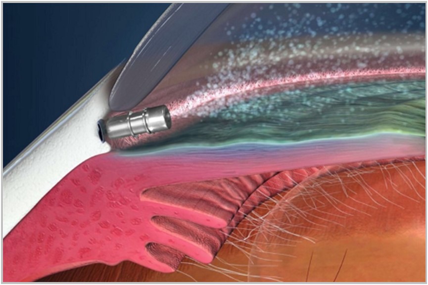 US FDA Approves Re-administration of Glaukos’ iDose TR