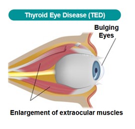 US FDA Approves First Challenger to Tepezza: Lumvoa from Viridian